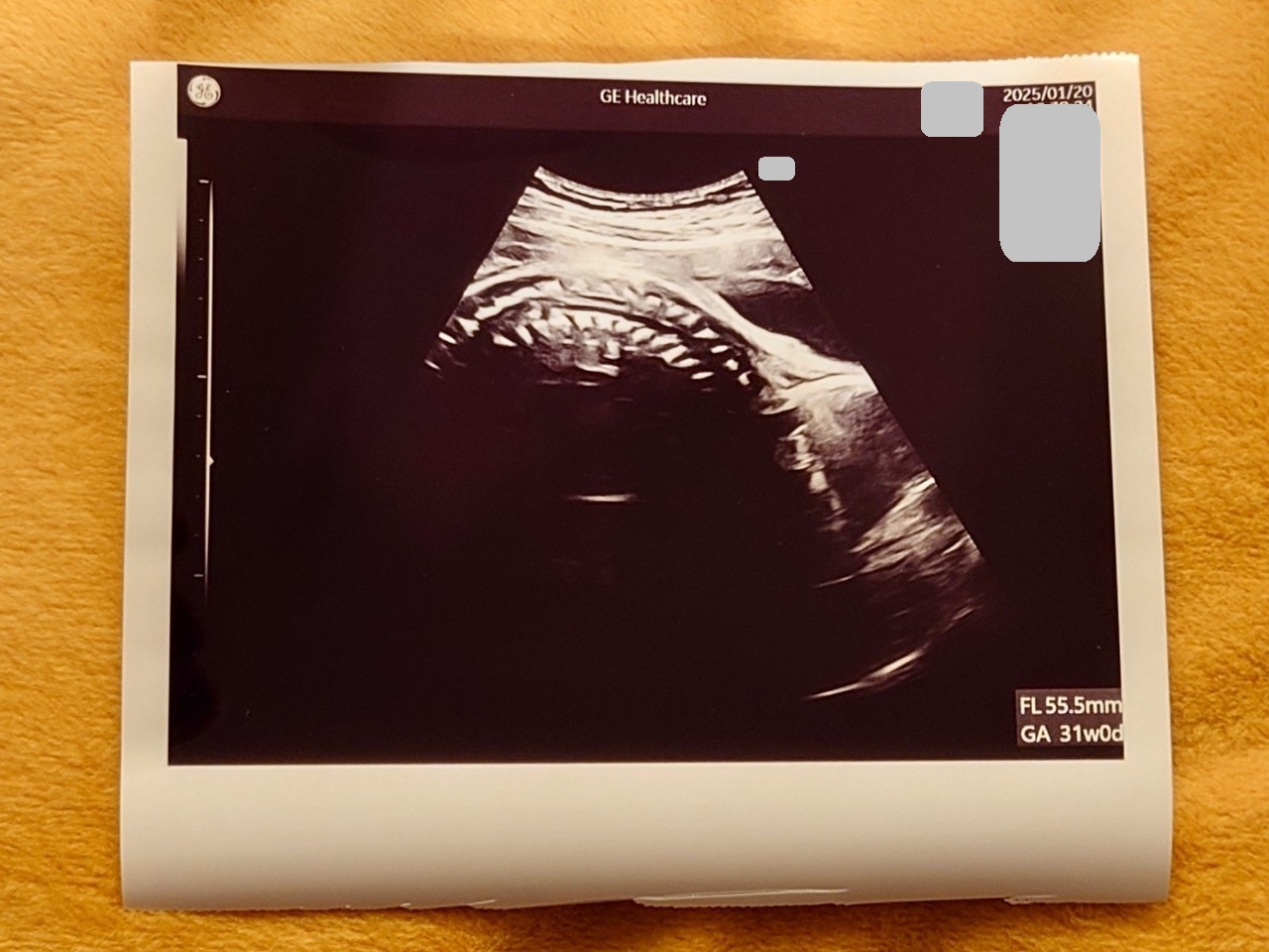 妊娠28週目の胎児の頭のエコー画像